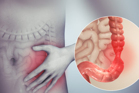 An image explaining what is IBS 