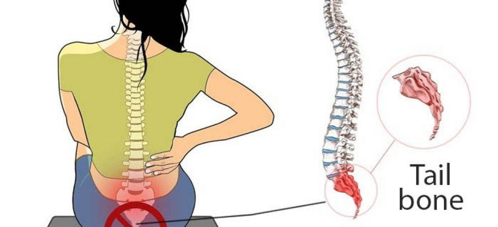 Coccydynia Or Tailbone Pain Homeopathic Treatment