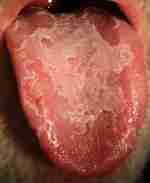 Geographic or Mapped Tongue of Natrum Mur Patient