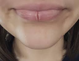 Crack in Midline of upper/lower lip in natrum mur