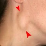 swollen cervical glands can be treated with Silicea