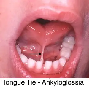 Tong-Tie in Tuberculinum children