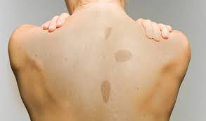 Coffee-Stained Birthmarks is a Sign to prescribe Carcinosin